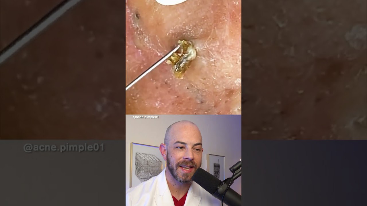 This is What Your Remove Blackheads Should Popping